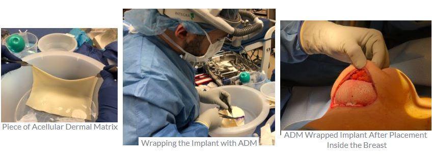 Prepectoral Breast Reconstruction Before and After