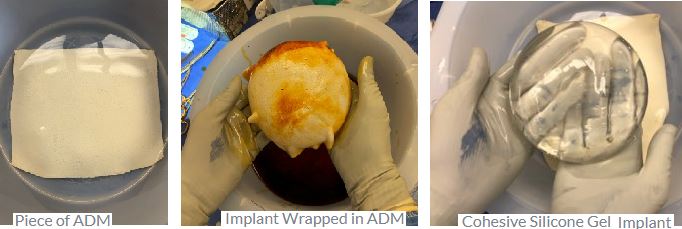 Preprectoral Breast Reconstruction Surgery