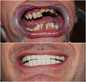 Before and After Porcelain Crowns Buenos Aires