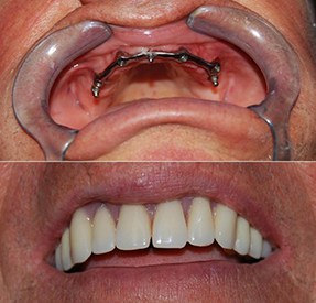 Before and After Dentures Buenos Aires