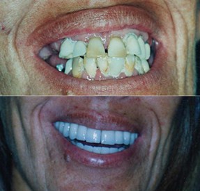 Before and After Porcelain Veneers Buenos Aires