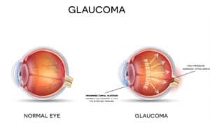 Glaucoma treatment in Leland, NC