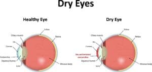 Dry eye treatment in Leland, NC