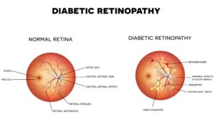 Diabetic retinopathy in Leland, NC