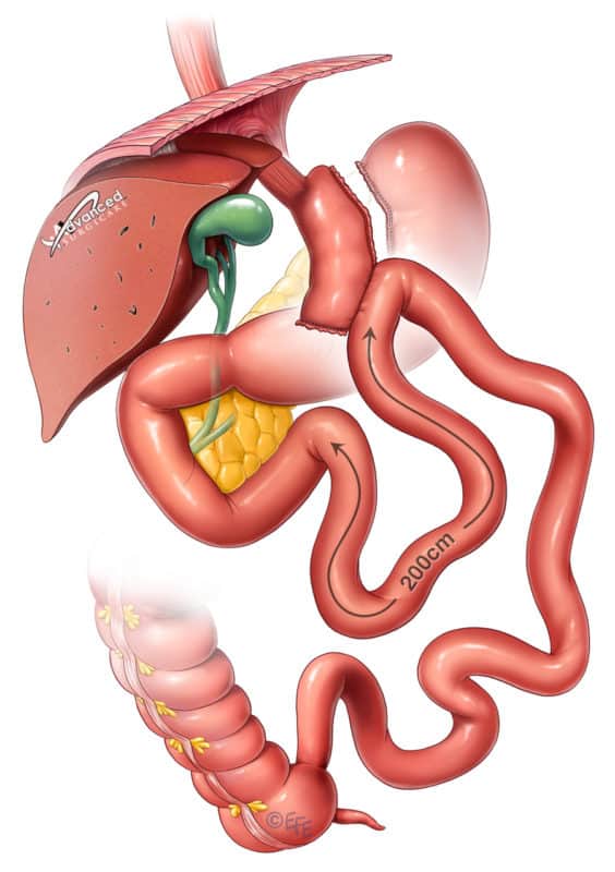 OmegaLoop Gastric Bypass Sydney Mini Gastric Bypass Sydney