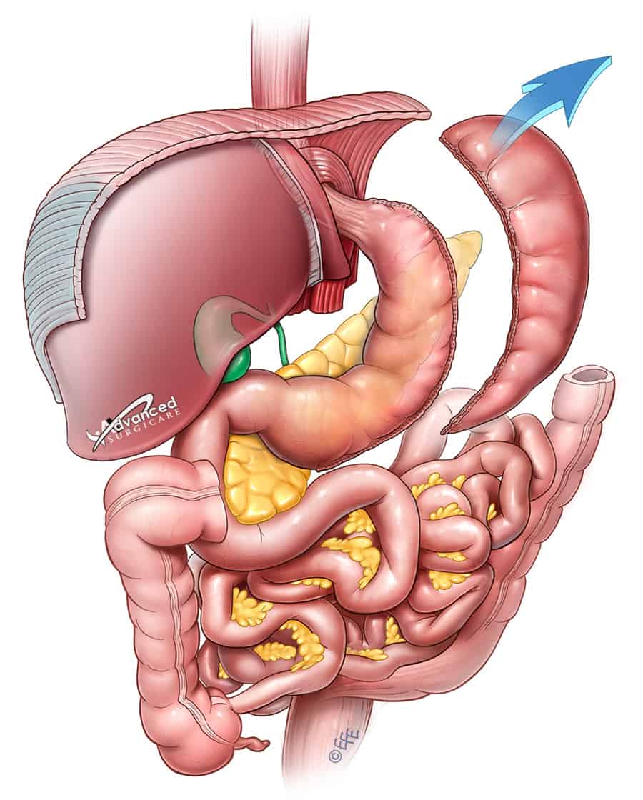 How Much Stomach is REMOVED in Gastric Sleeve? - Body Genesis