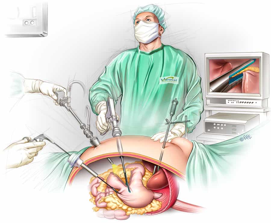 Gastric Sleeve Surgery Sydney