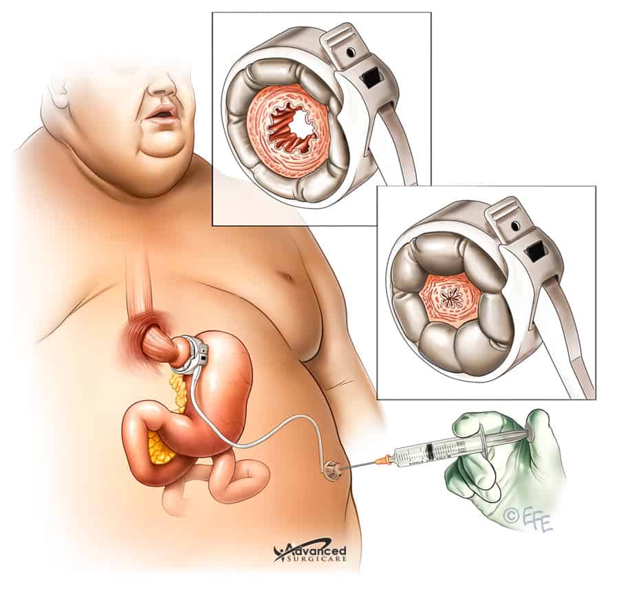 How Much Is A Lap Band Procedure