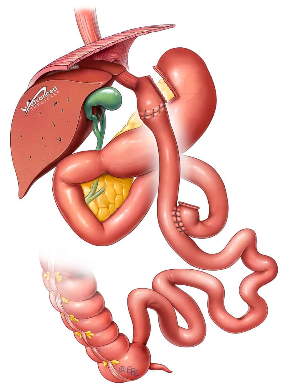 stomach procedure