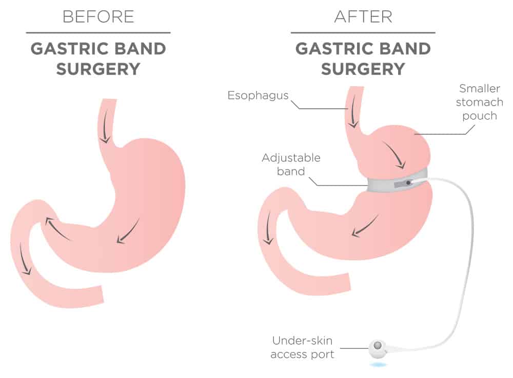 Lap Band Surgery Sydney Laparoscopic Adjustable Gastric Banding