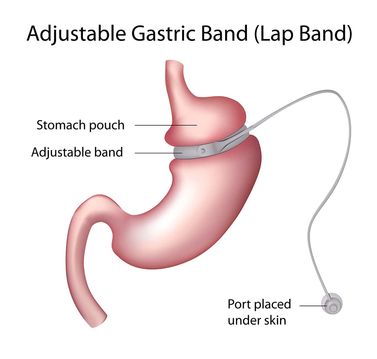 Adjustable gastric banding in Sydney