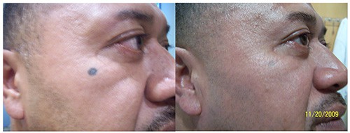 Facial Tattoo Removal Before After