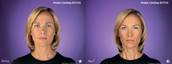 BOTOX Treatment Results JupiterFL