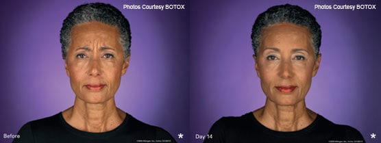 BOTOX therapy Patient Before After Photos Jupiter, FL