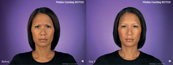 Botox Injection Patient Photos Jupiter, FL