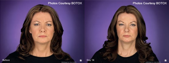 Botox Patient Before After Jupiter, FL