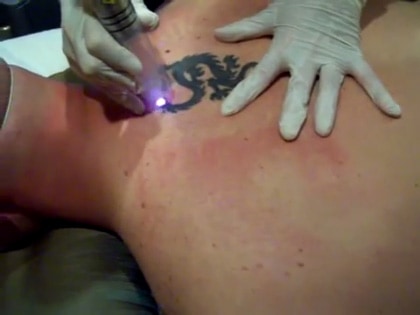 What Are The Benefits OF Tattoo Removal