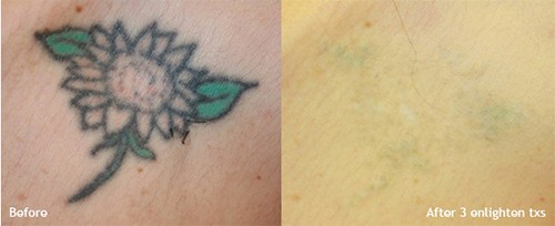 Top 10 Best Tattoo Removal in Saint Petersburg FL  June 2023  Yelp