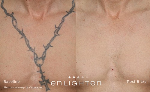 Patient 45874796  PicoPlus Tattoo Removal Before  After Photos   HolcombKreithen Plastic Surgery  Medspa