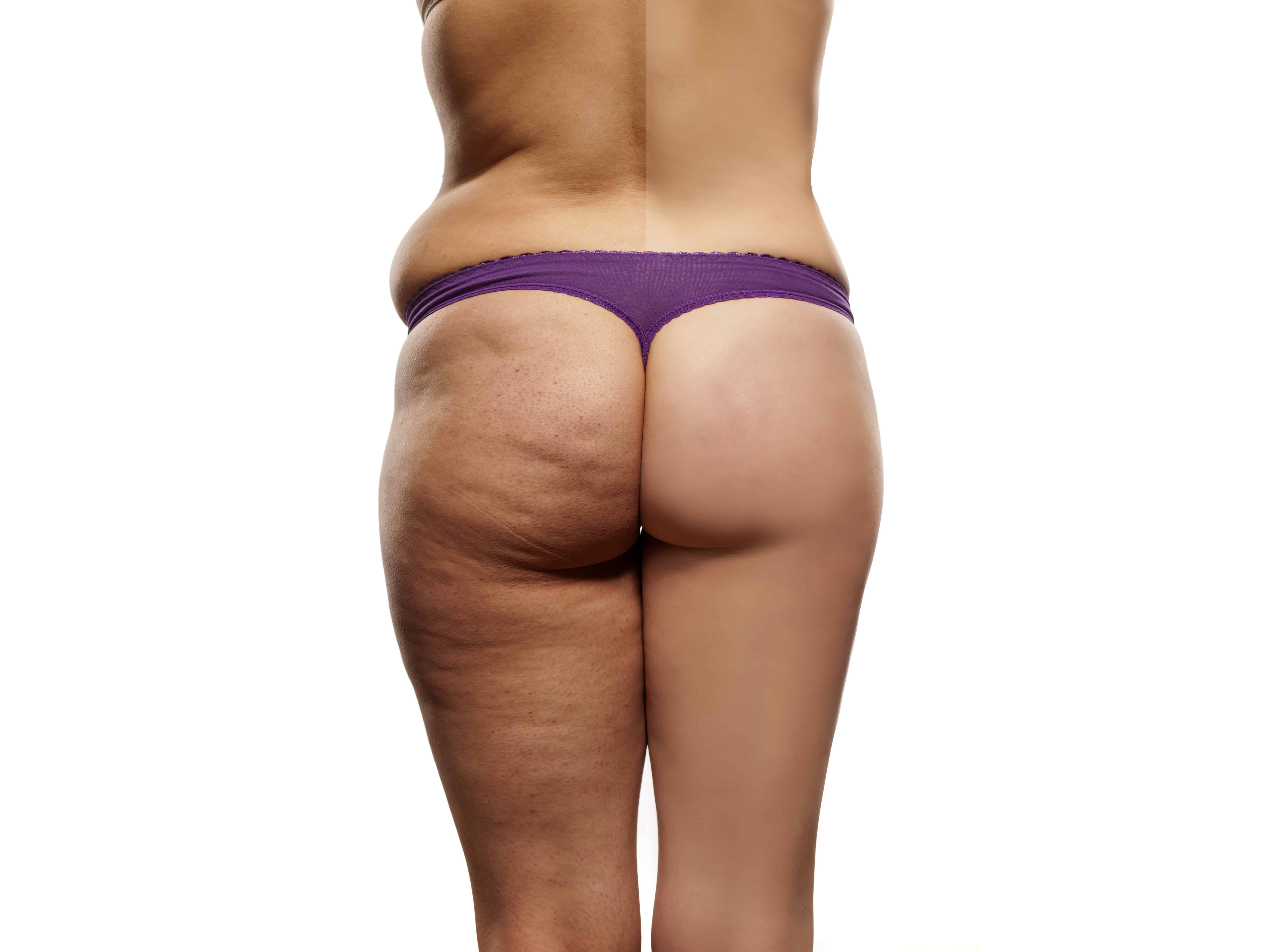 The Only Guide for How To Get Rid Of Cellulite Naturally - Glamrs Skin Care thumbnail