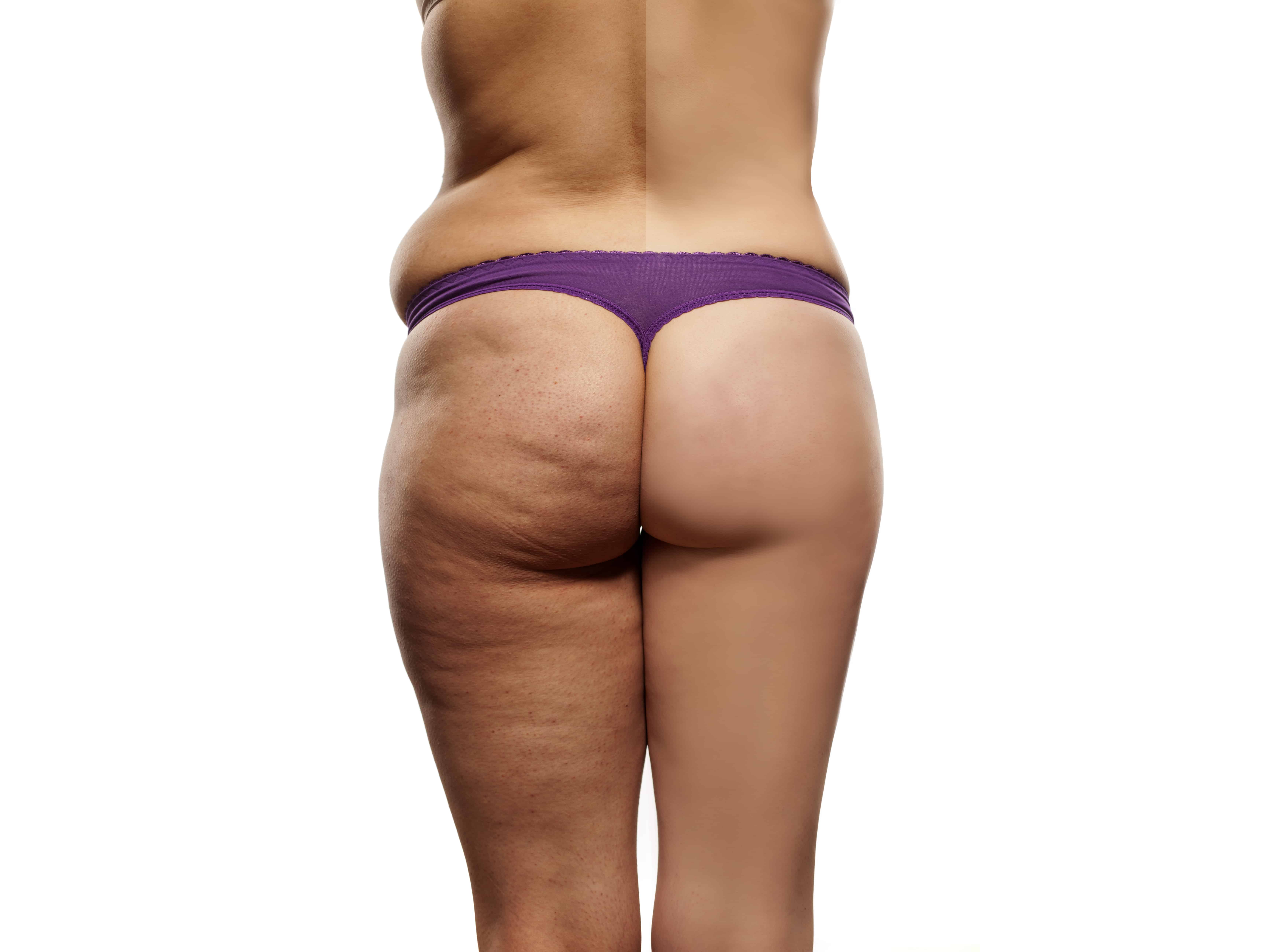 7 Easy Facts About Cellulite Treatments: What Really Works? Shown thumbnail