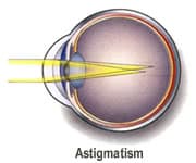 Austin tx astigmatism correction