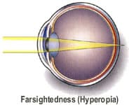 Austin tx farsightedness correction