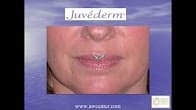 Lip rejuvenation with Juvederm