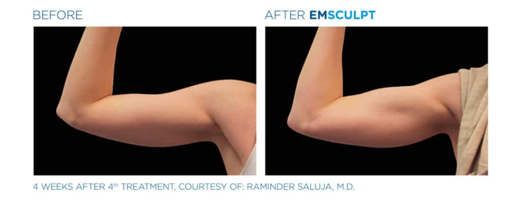 Emsculpt_Bicep Before & After