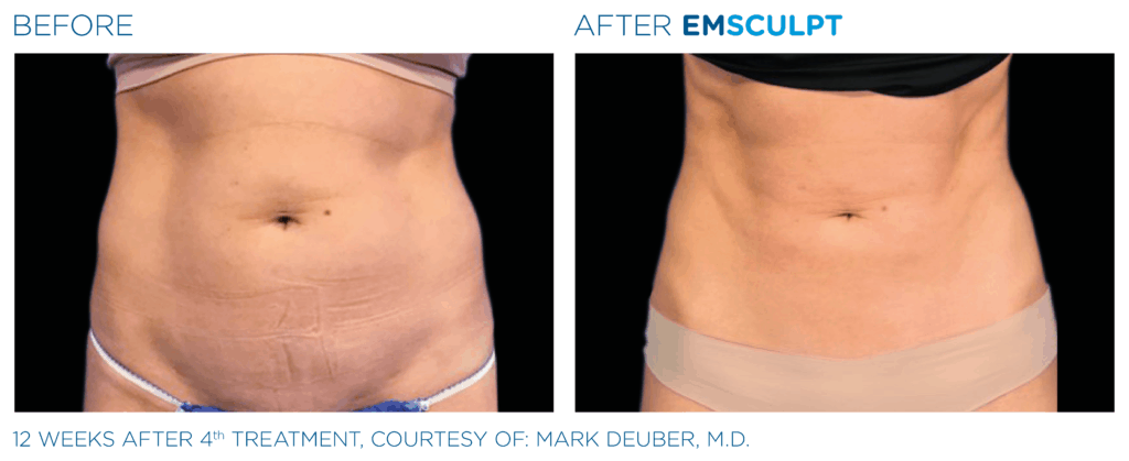 Emsculpt_Before & After Female