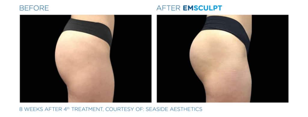 Emsculpt_Butt Before & After