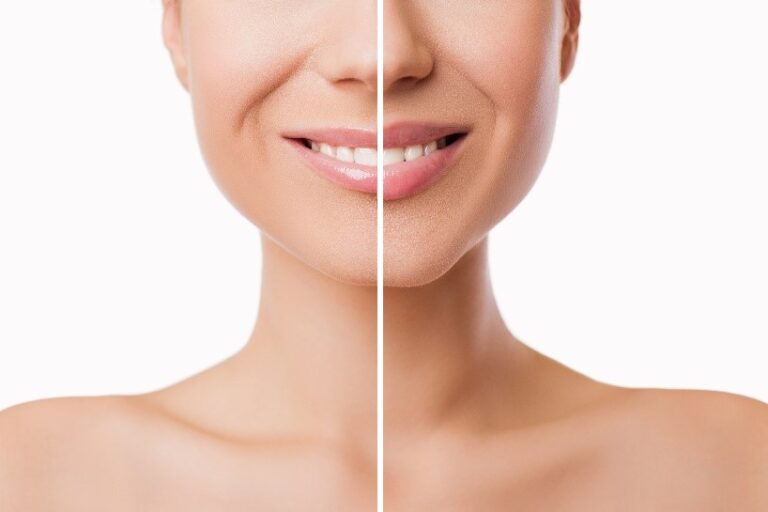 kysse lip filler kysse lip filler