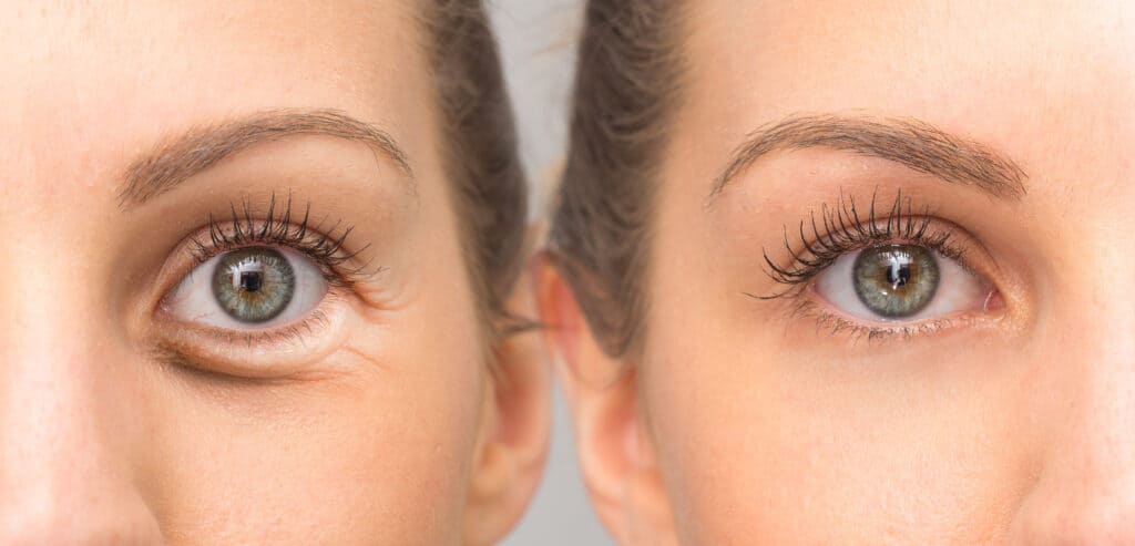 Cosmetic Eye Procedures in Boston