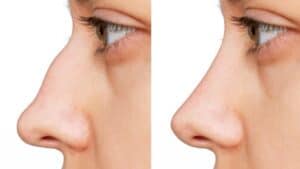 Preservation Rhinoplasty Boston