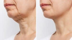 Recontouring Neckline Boston