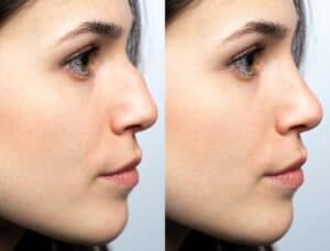 Rhinoplasty Boston