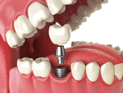 Dental implants Los Gatos