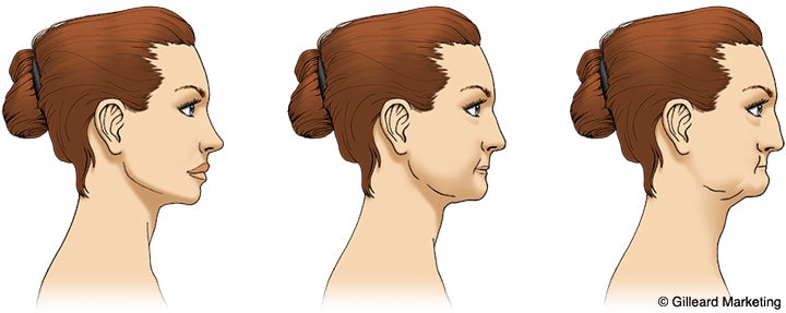 Jaw bone resorption diagram