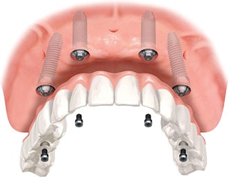 Illustration of upper arch using four implants