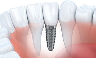 Single-Tooth Dental Implants in San Jose