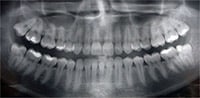 Panoramic X-Ray image