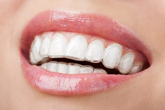 Invisalign - Bay Area Orthodontics