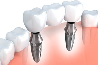 Implant-Supported Bridge Options in San Jose