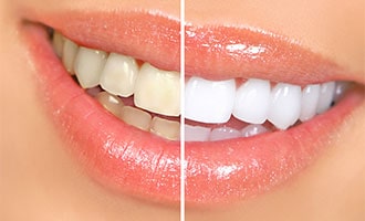 Teeth Whitening San Jose