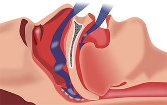 Diagram of sleep apnea