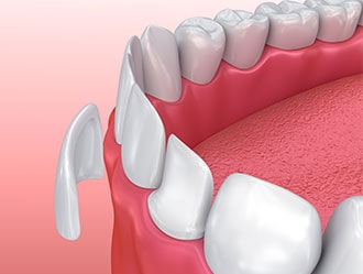 Close-up diagram of a porcelain veneer