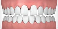 Gapped Dental bite Example Image
