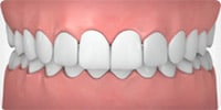 Over-bite Example Image
