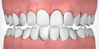 Over-Crowded Dental Bite Example Image