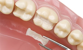 Dental Crowns in San Jose